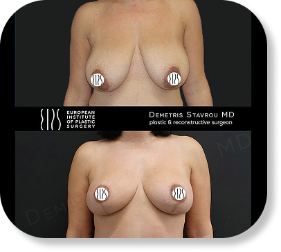 Breast Lift (Mastopexy)