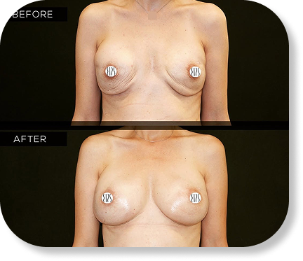 Breast reconstruction