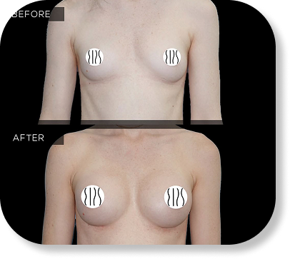 Breast Augmentation