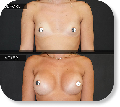 Breast Augmentation