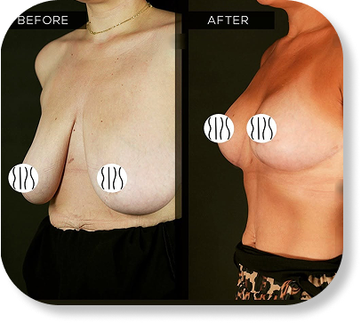 Breast Reduction