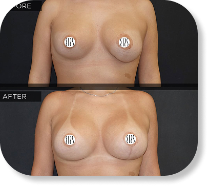Implant Revision & replacment